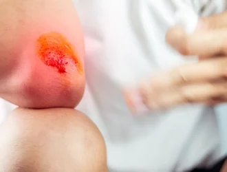 Cuts, Burns, Injuries