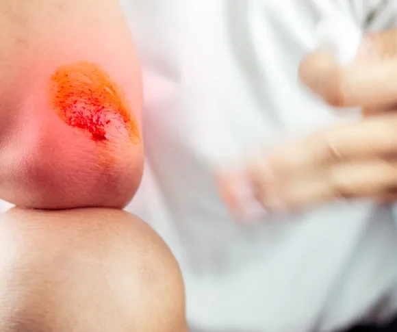 Cuts, Burns, Injuries