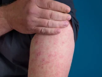 Home Doctor for Cellulitis