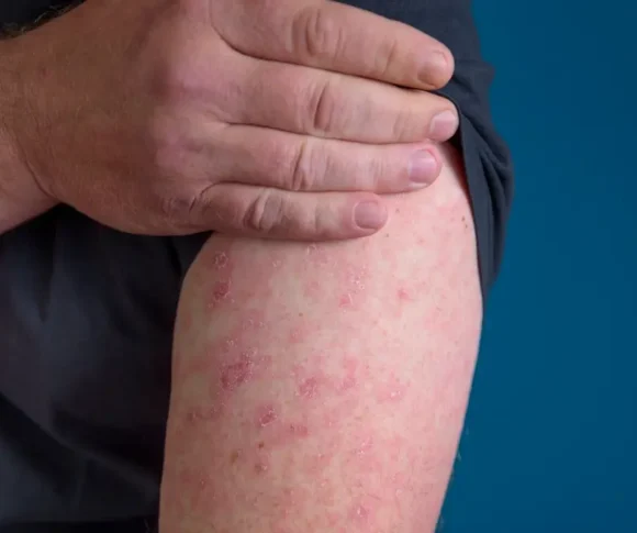 Home Doctor for Cellulitis