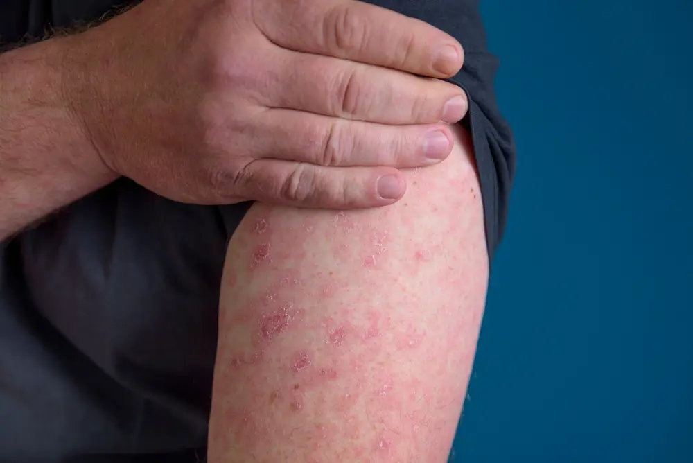 Home Doctor for Cellulitis