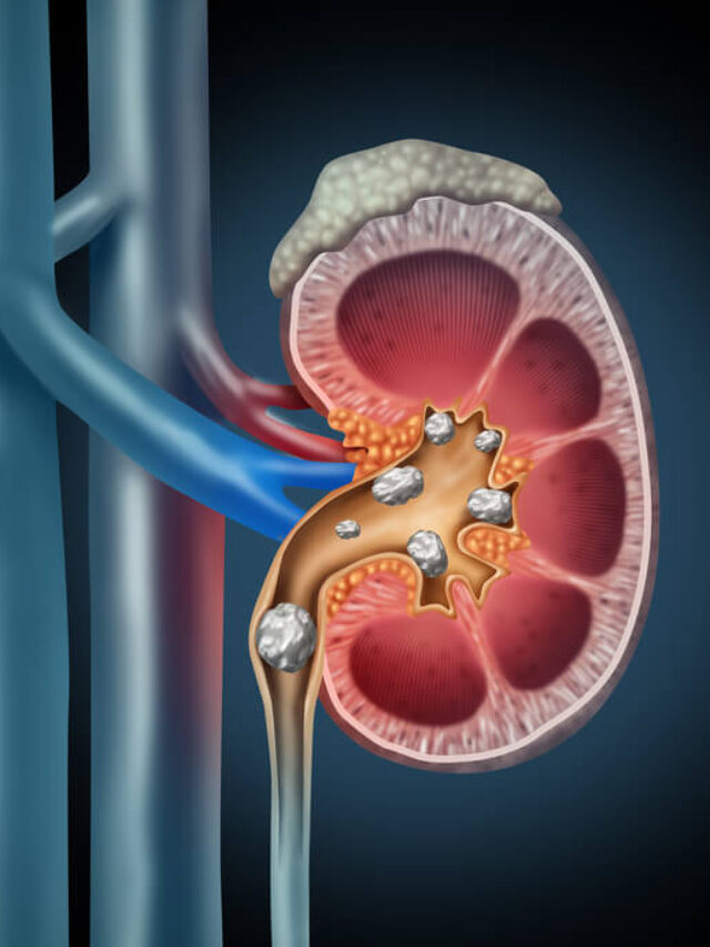 kidney stone symptoms